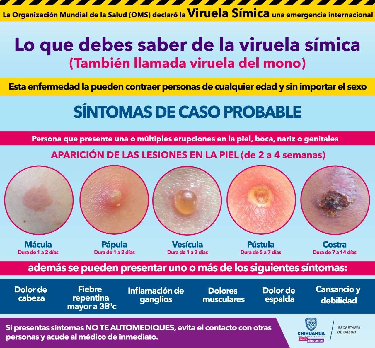 ¿Conoces los síntomas de la viruela del mono y cómo prevenirla?
